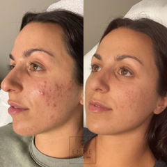 Saltfacial Before And After Image | EMME Medical Spa | Orchard Park, NY