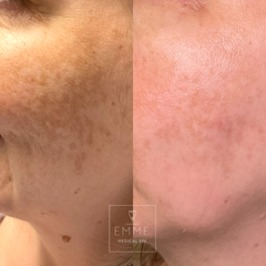 ZO Skin Before And After Image | EMME Medical Spa | Orchard Park, NY