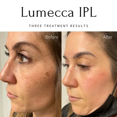 Lumecca IPL Before and After Image | EMME Medical Spa | Orchard Park, NY