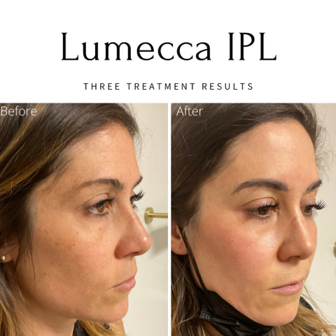 Lumecca IPL Before and After Image | EMME Medical Spa | Orchard Park, NY