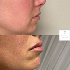 Fillers Before And After Images | EMME Medical Spa | Orchard Park, NY