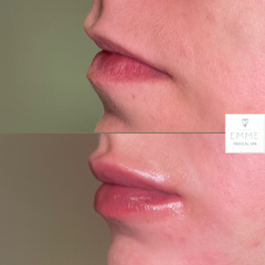 Fillers Before And After Images | EMME Medical Spa | Orchard Park, NY