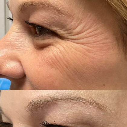 Xeomin Before And After Image | EMME Medical Spa | Orchard Park, NY
