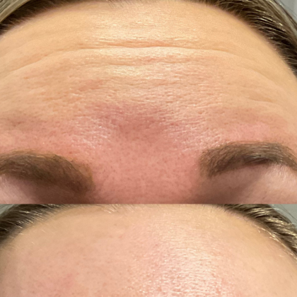 Xeomin Before And After Image | EMME Medical Spa | Orchard Park, NY