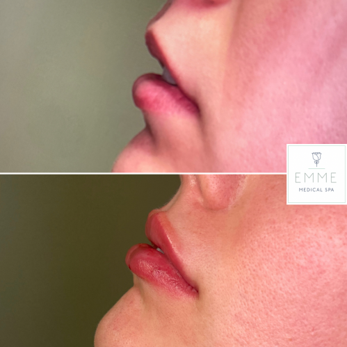 Fillers Before And After Image | EMME Medical Spa | Orchard Park, NY