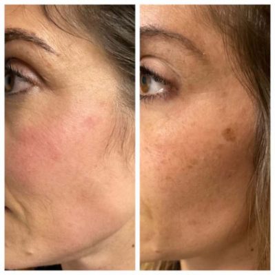 SKIN BRIGHTENING Before And After Image | EMME Medical Spa | Orchard Park, NY