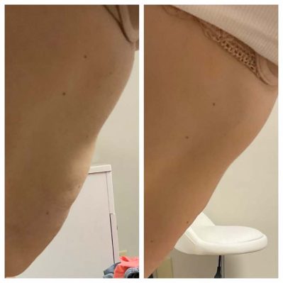 Morpheus8 Before And After Image | EMME Medical Spa | Orchard Park, NY