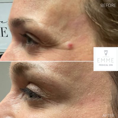 Fillers Before And After Image | EMME Medical Spa | Orchard Park, NY